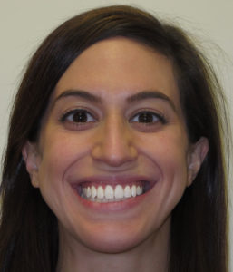 Improving A Bite Relationship with Lingual Braces - After
