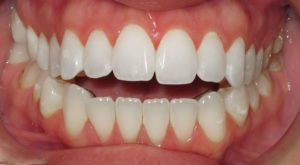IMPROVING A BITE RELATIONSHIP WITH LINGUAL BRACES - BEFORE