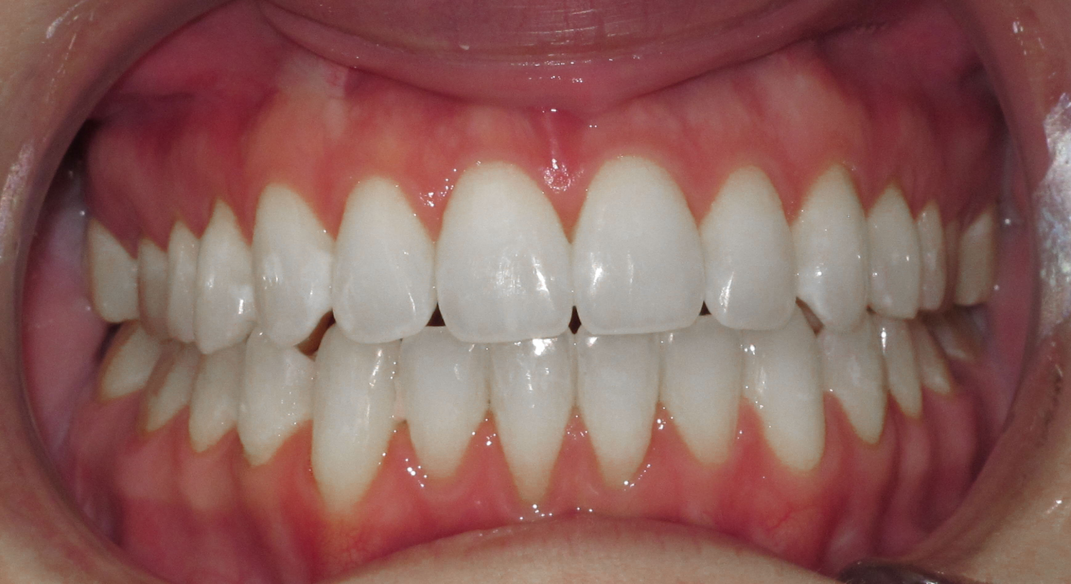 IMPROVING A BITE RELATIONSHIP WITH LINGUAL BRACES - AFTER