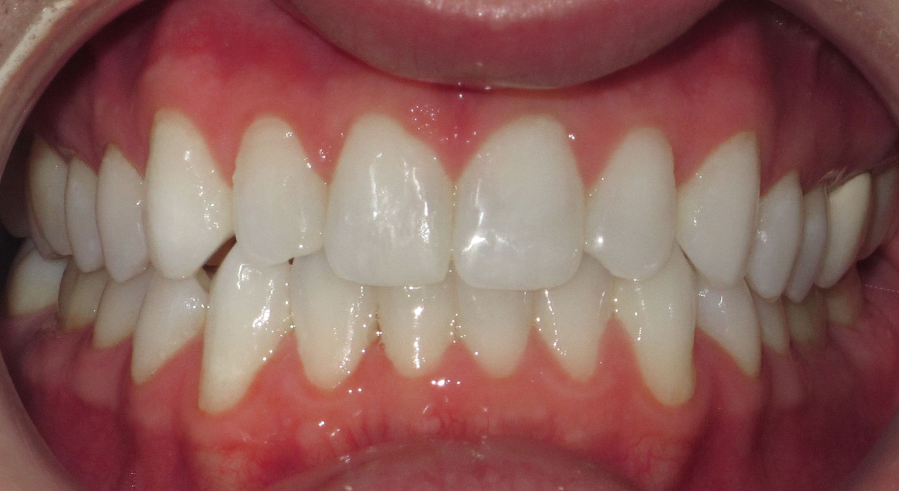 IMPROVING AESTHIC ALIGNMENT WITH LINGUAL BRACES - BEFORE