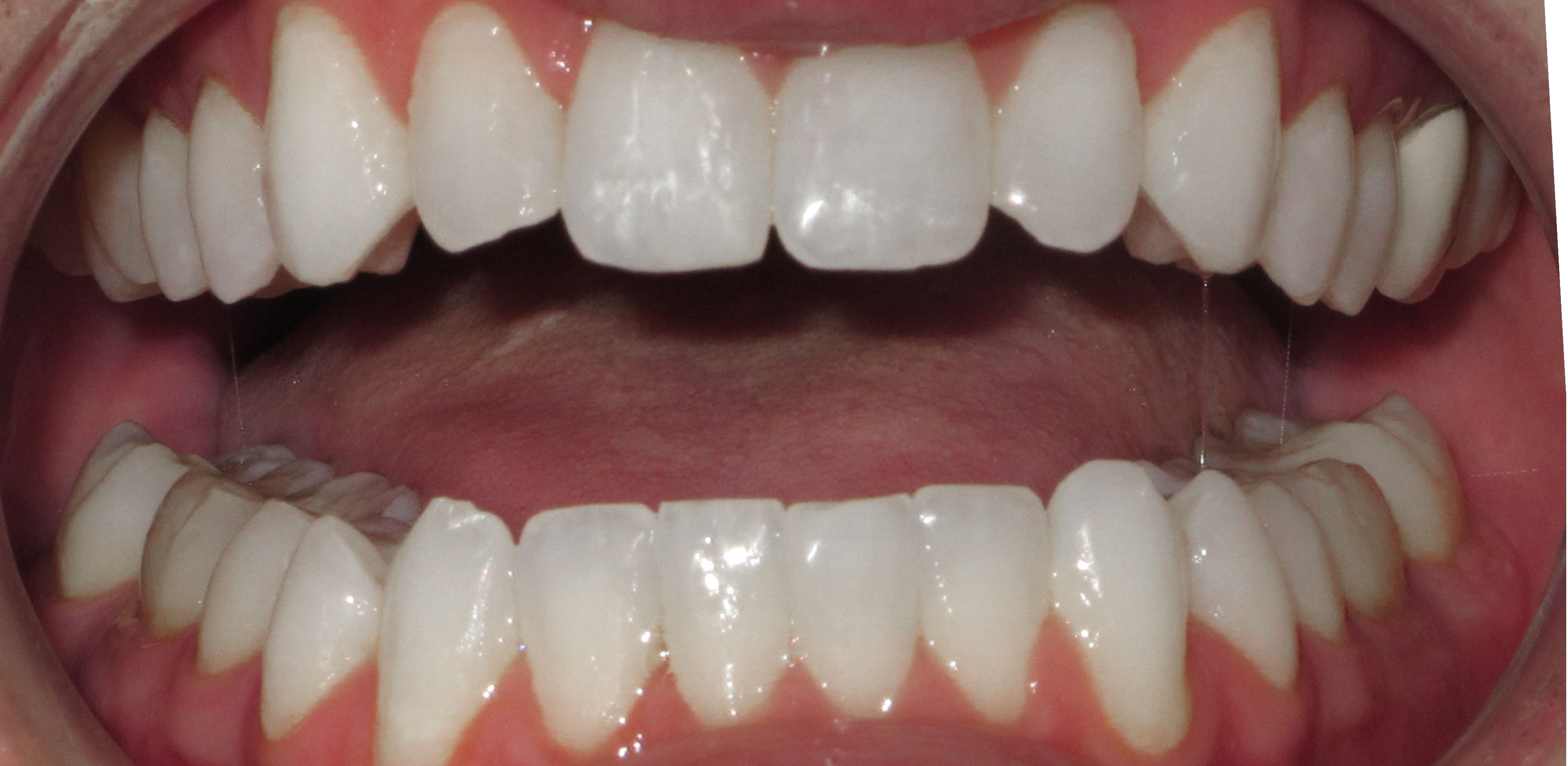 IMPROVING AESTHIC ALIGNMENT WITH LINGUAL BRACES - AFTER