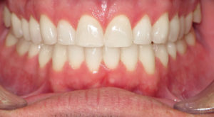 FIXING ALIGNMENT WITH BRACES - AFTER
