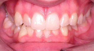 ELIMINATING TEETH CROWDING WITH LINGUAL BRACES - BEFORE
