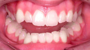 ELIMINATING TEETH CROWDING WITH LINGUAL BRACES - BEFORE