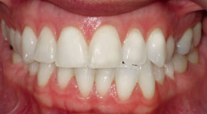 LINGUAL BRACES FOR A WIDER SMILE - BEFORE