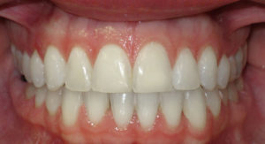 LINGUAL BRACES FOR A WIDER SMILE - AFTER
