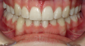 ELIMINATING TEETH CROWDING WITH LINGUAL BRACES - AFTER