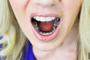 The Benefits of Lingual Braces - Mouth View