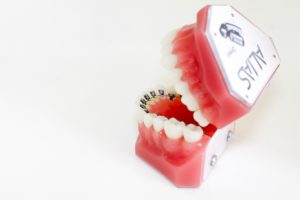The History of Lingual Braces - The Alias Lingual System